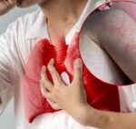 Veracruz se ubica en primer lugar nacional en casos confirmados de tuberculosis respiratoria al inicio de 2026