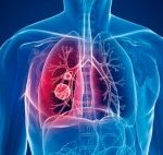 Tuberculosis afecta a una gran cantidad de países en el mundo, es más contagiosa que el COVID-19