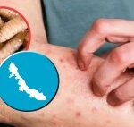 Catorce veracruzanos sufren infecciones por larva del gusano barrenador; entidad es cuarto lugar nacional en contagios humanos